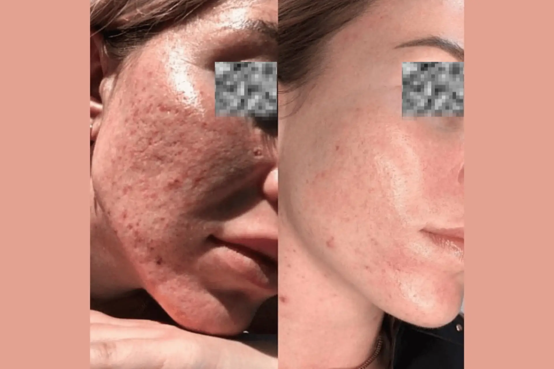 Skinetica before and after (1)