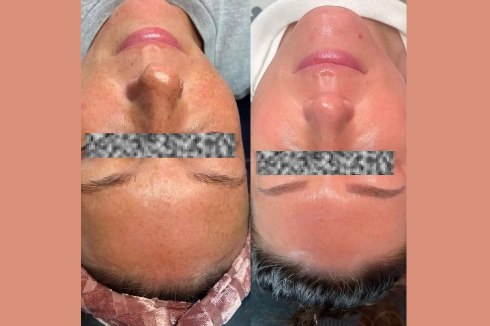 Skinetica before and after (1)