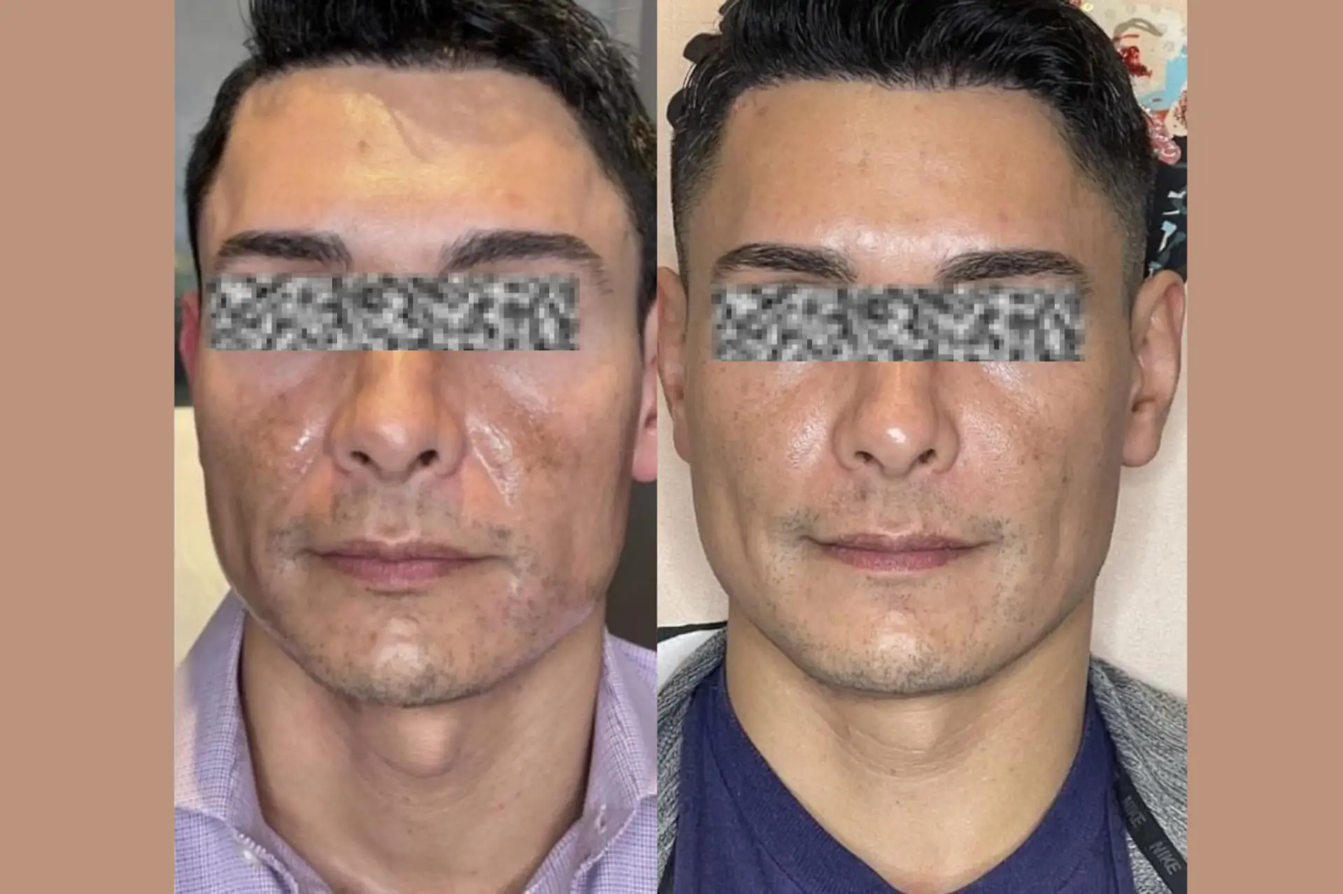 Skinetica before and after (1)