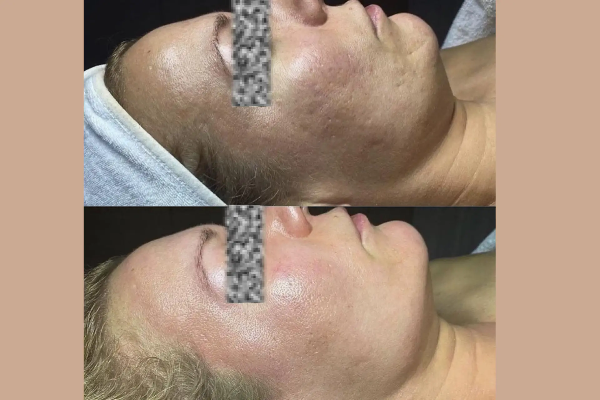 Skinetica before and after (1)