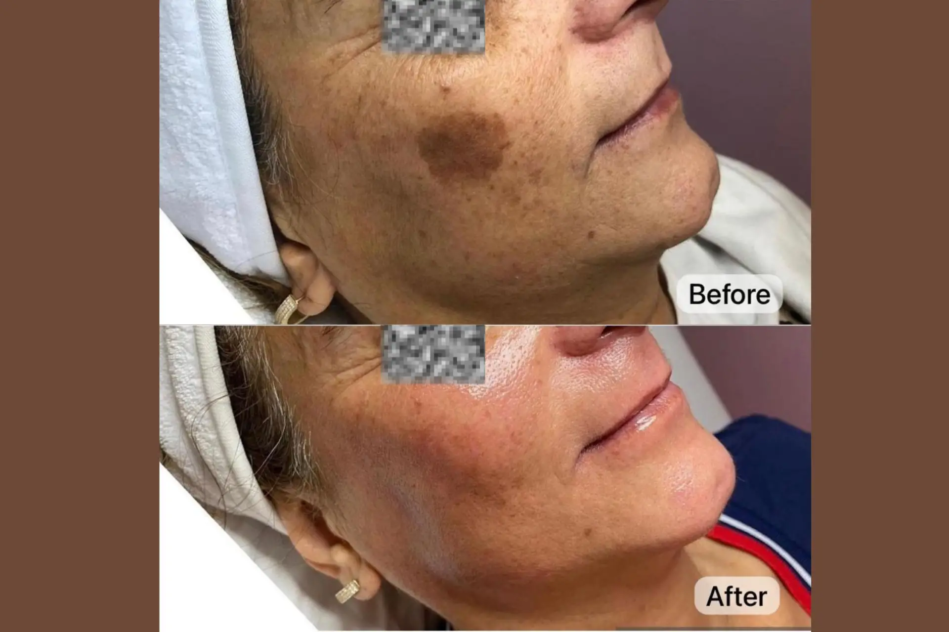 Skinetica before and after (1)