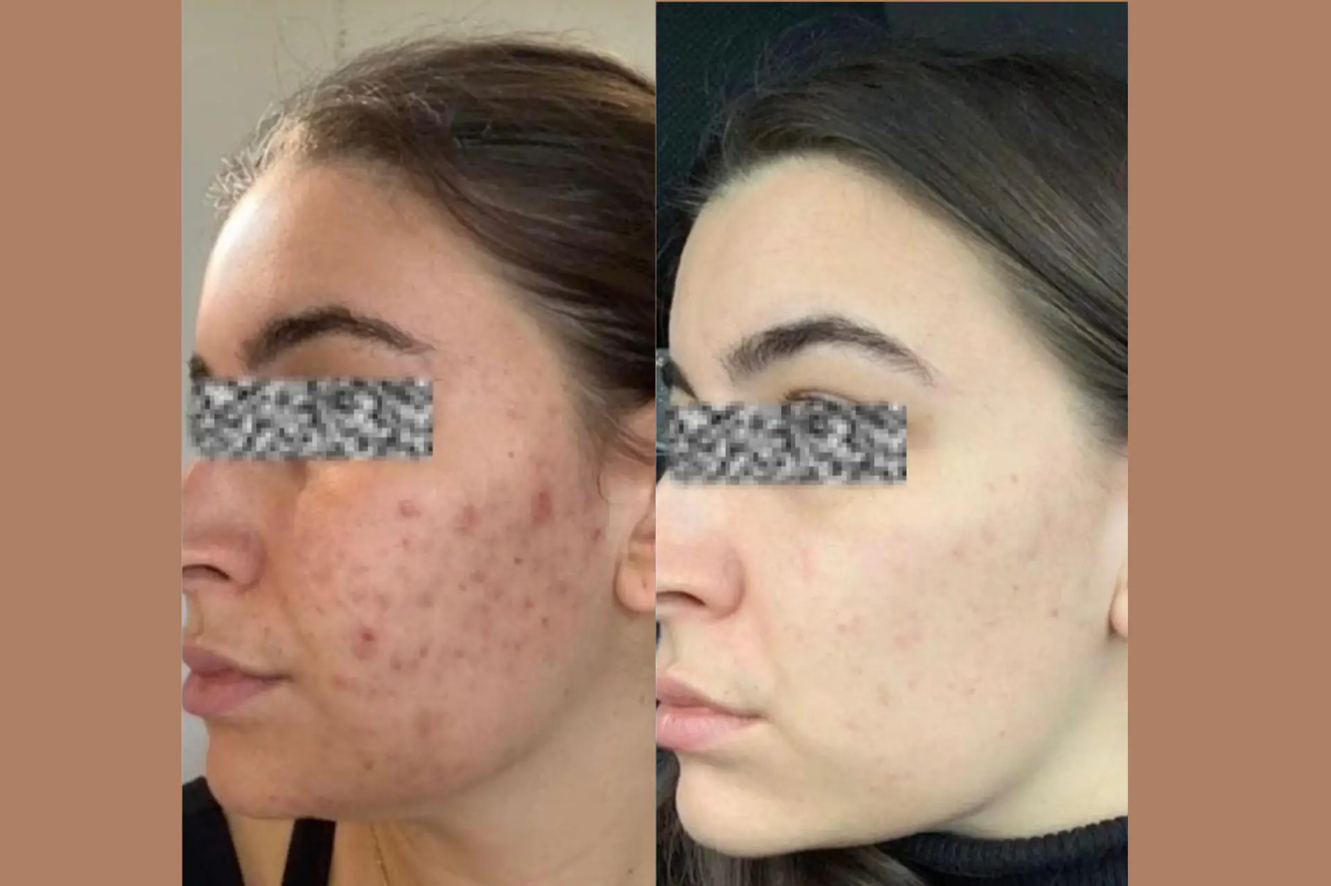 Skinetica before and after (1)