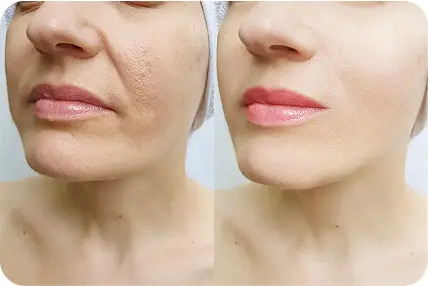 Skinetica before and after (1)