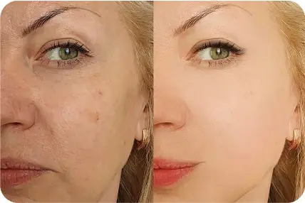 Skinetica before and after