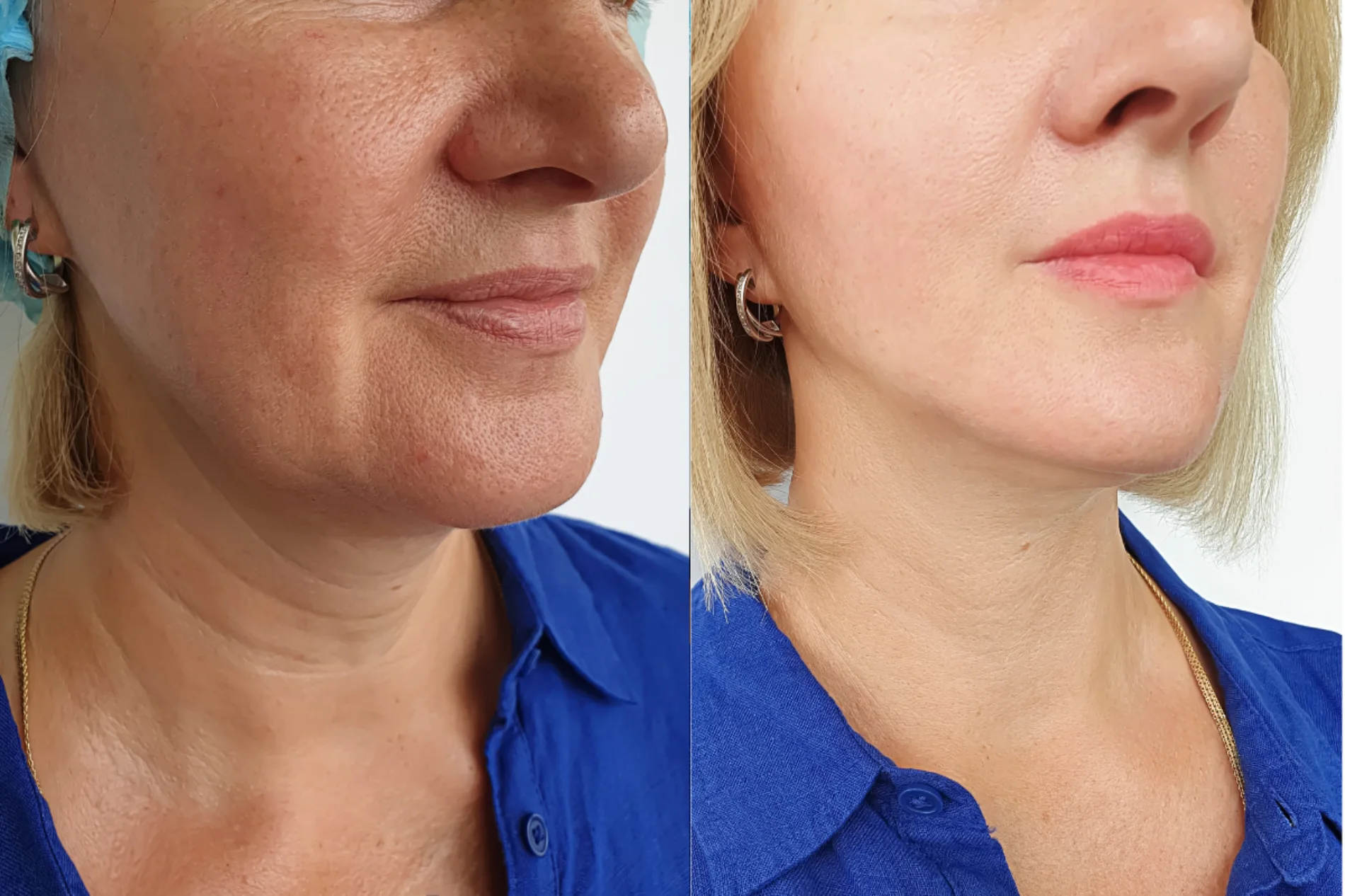 Skinetica before and after (1)